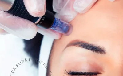 Dermapen o Microneedling: Innovación y Precisión en el Rejuvenecimiento Facial